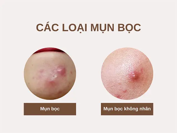 mun-boc-khong-dau-co-tu-xep-khong-8